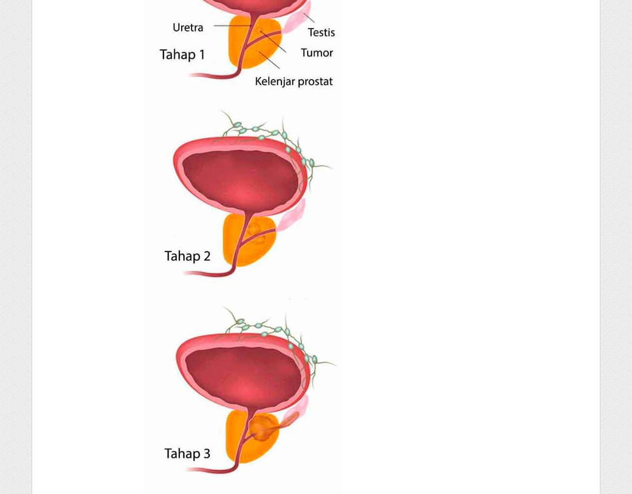 Prostaform 3